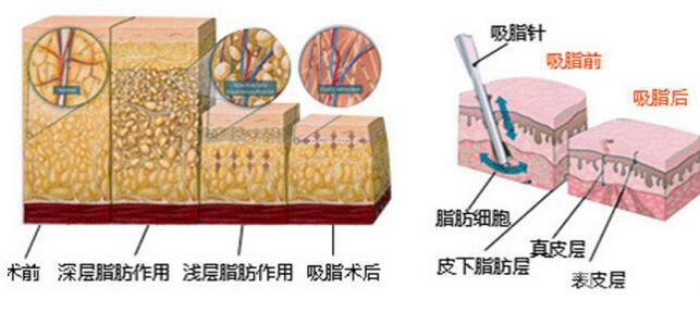 抽脂多少錢 做抽脂手術(shù)貴不貴？