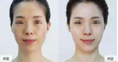 成都自體脂肪填充多少錢？