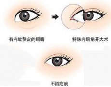 深圳開(kāi)眼角多少錢(qián)