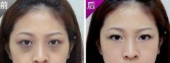 深圳激光去黑眼圈需要多少錢(qián)
