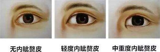 上海眼部整形失敗修復(fù)價(jià)格