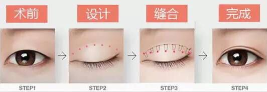 焊接雙眼皮是什么？有哪些特點(diǎn)？