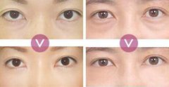 超聲波去眼袋價(jià)格、果能保持多久