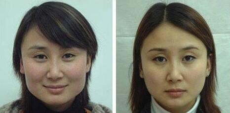顴骨顴弓,整形,風(fēng)險,注意事項