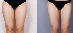 大腿吸脂2000能瘦多少？大概幾厘米？