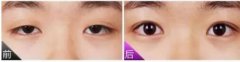 上瞼提肌手術(shù)有必要嗎？不做有什么危害？
