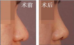 自體軟骨隆鼻是*的嗎？有哪些優(yōu)勢(shì)？