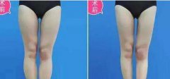 大腿吸脂后多久開始瘦？多久恢復(fù)？