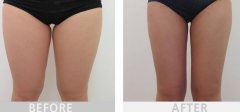 大腿吸脂3500能瘦多少？多久開始瘦？