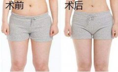 大腿吸脂有幾個(gè)切口？大腿環(huán)吸幾個(gè)切口？