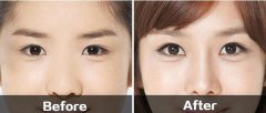 開眼角有風(fēng)險么？怎么預(yù)防？