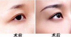 種植眉毛的適合人群有哪些？眉毛種植果圖？