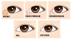 開眼角手術(shù)風(fēng)險大嗎？如何規(guī)避？