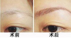 種植眉毛是怎么回事？種植眉毛有什么作用？
