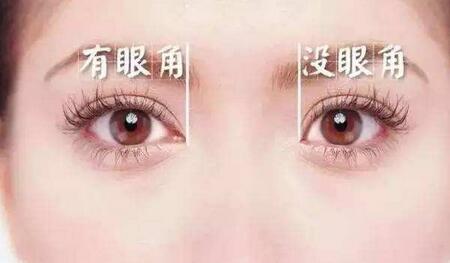 開眼角恢復(fù)時(shí)間要多久？多久恢復(fù)自然？
