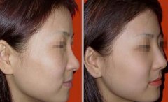 隆鼻以后怎么恢復(fù)快，術(shù)后如何護理?