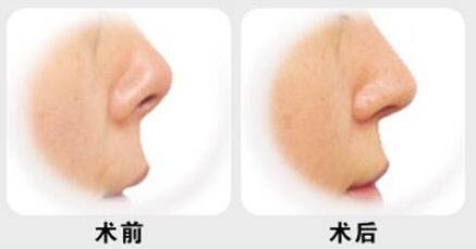 北京,自體墊鼻子,多少錢(qián),費(fèi)用