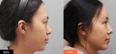 隆鼻多久消腫自然，術(shù)后多久能恢復(fù)？