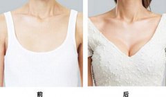 假體豐胸能保持多久，假體豐胸果可以維持多久？