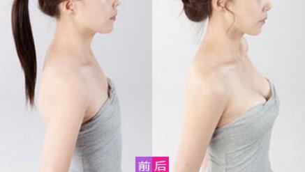 威寧假體豐胸怎么樣？威寧假體豐胸*果如何？