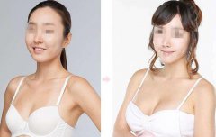 上海假體豐胸手術(shù)多少錢？上海假體豐胸價(jià)格？