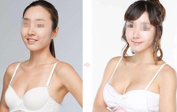 上海,假體豐胸手術,多少錢,價格