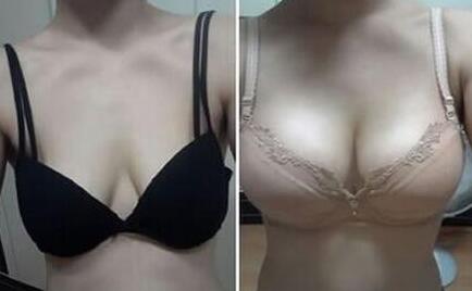 上海假體豐胸費(fèi)用、上海假體豐胸手術(shù)多少錢？