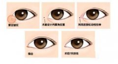 韓式開眼角手術(shù)果怎么樣？開眼角前后照