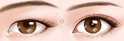 做開(kāi)眼角大概多少錢？做開(kāi)眼角的價(jià)格