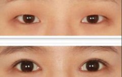 做開眼角價(jià)格、開眼角費(fèi)用詳細(xì)解析