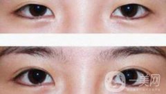 割雙眼皮多少錢？雙眼皮手術(shù)費(fèi)用詳細(xì)解答