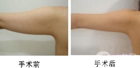 手臂吸脂術(shù)*嗎？手臂吸脂有危險(xiǎn)嗎？