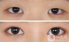 開(kāi)眼角需要多少錢？開(kāi)眼角和不開(kāi)的區(qū)別圖