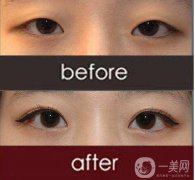 改臉型手術(shù)多少錢？改臉型手術(shù)有危險(xiǎn)嗎？