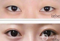 雙眼皮開(kāi)眼角價(jià)格是多少？割雙眼皮開(kāi)眼角多少錢？