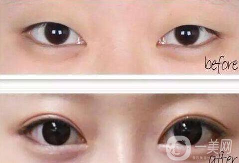 雙眼皮開眼角價格是多少？割雙眼皮開眼角多少錢？