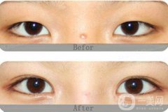 開(kāi)眼角割雙眼皮價(jià)格、開(kāi)眼角割雙眼皮多少錢？
