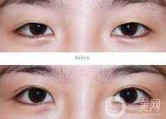 成都割雙眼皮哪里專業(yè)？割雙眼皮介紹？