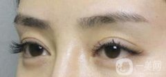 上海自體脂肪豐眉弓價(jià)格、自體脂肪豐眉弓多少錢