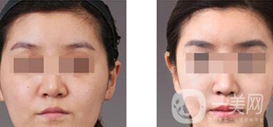 上海自體脂肪豐眉弓價(jià)格、自體脂肪豐眉弓多少錢