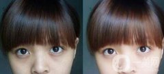 黑眼圈可以打玻尿酸嗎？玻尿酸去黑眼圈果如何？