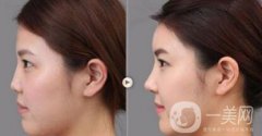 上海假體隆鼻多少費用？假體隆鼻價格詳細分析