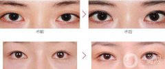 杭州割雙眼皮價格貴不貴？價格是多少？