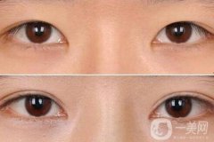 割雙眼皮后注意什么？術(shù)后注意事項盤點~