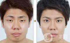 男士割雙眼皮果怎樣？有哪些方式？
