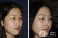 廣東硅膠隆鼻需要多少錢呢？廣東硅膠隆鼻價(jià)格？