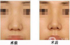 上海膨體隆鼻多少費(fèi)用？上海膨體隆鼻多少錢？