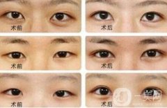 開(kāi)眼角大概多少錢(qián)？開(kāi)眼角價(jià)格一般是多少？