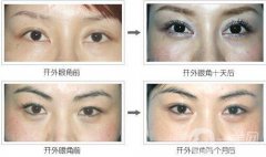 開(kāi)眼角增生多久恢復(fù)?開(kāi)眼角增生恢復(fù)時(shí)間？