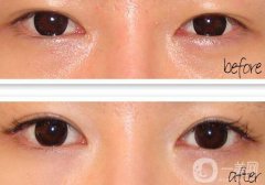 開(kāi)眼角疼嗎？開(kāi)眼角痛不痛？